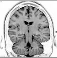 Normal coronal brain (Radiopaedia 6676-7910 B 26).jpg