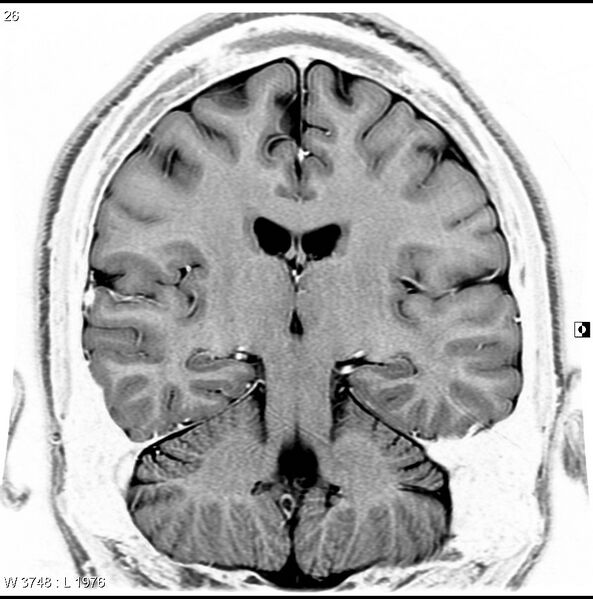 File:Normal coronal brain (Radiopaedia 6676-7910 B 26).jpg