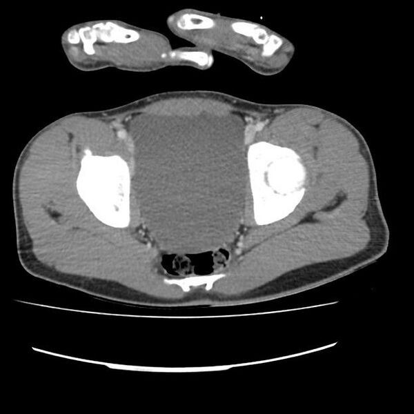 File:Normal dual-phase trauma CT chest,abdomen and pelvis (Radiopaedia 48092-52899 A 106).jpg