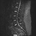 Normal lumbar spine MRI (Radiopaedia 47857-52609 Sagittal STIR 8).jpg