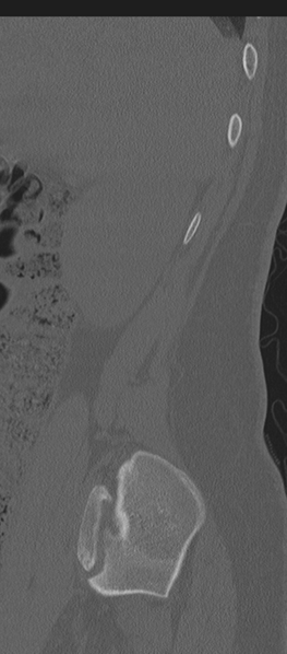 File:Normal lumbosacral CT (Radiopaedia 37923-39867 Sagittal bone window 90).png