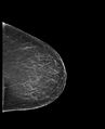 Normal mammography (low density breasts) (Radiopaedia 77169-89175 C 1).jpg