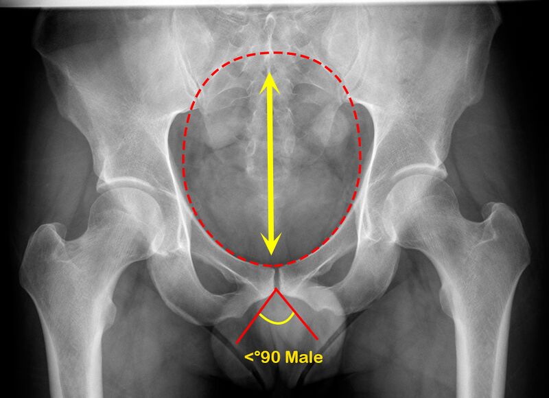 File:Normal pelvis- gender differences (Radiopaedia 43111-46396 Male 1).jpg