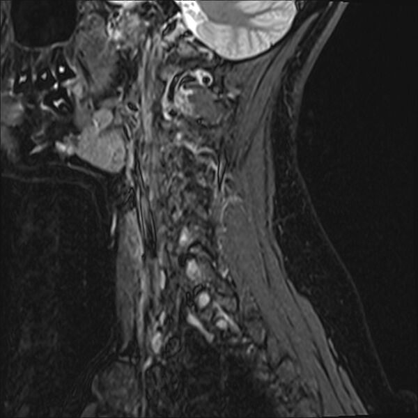 File:Normal trauma cervical spine MRI (Radiopaedia 32130-33071 Sagittal STIR 15).jpg