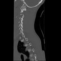 Normal trauma spine imaging (age 16) (Radiopaedia 45335-49358 Sagittal bone window 8).jpg
