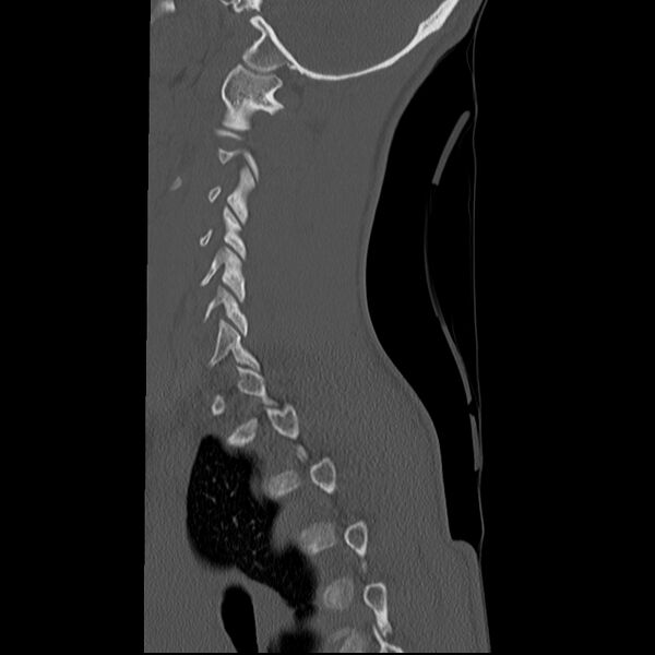 File:Normal trauma spine imaging (age 16) (Radiopaedia 45335-49358 Sagittal bone window 8).jpg