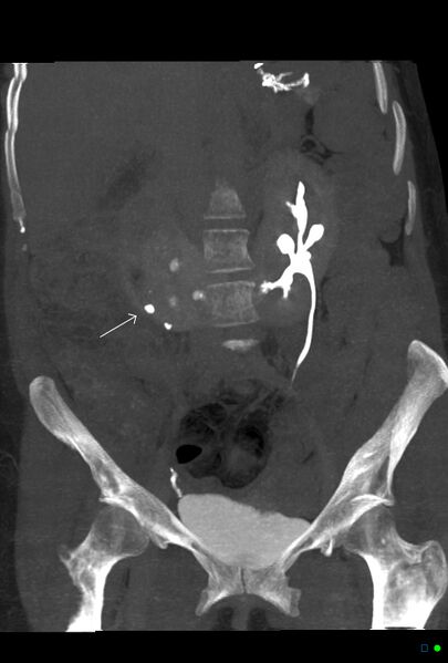 File:Obstructed infected horseshoe kidney (Radiopaedia 18116-17898 C 1).jpg