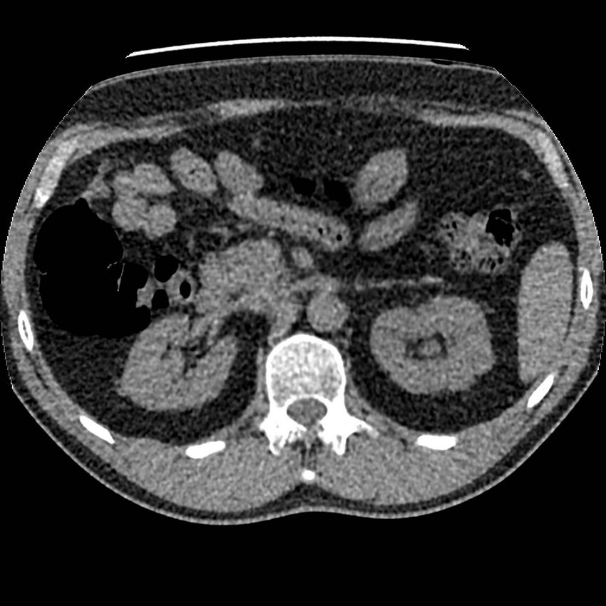 Obstructing ureteric calculus and ureteric anatomy (Radiopaedia 62730-71042 Axial non-contrast 28).jpg