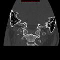 Occipital condyle fracture (Radiopaedia 18366-18208 Coronal bone window 12).jpg