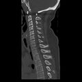 Occipital condyle fracture (Radiopaedia 31755-32691 Sagittal bone window 22).jpg