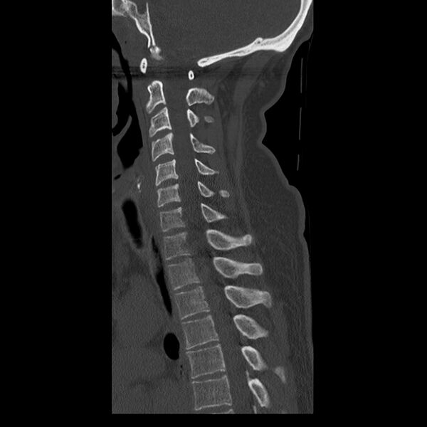 File:Occipital condyle fracture (Radiopaedia 31755-32691 Sagittal bone window 22).jpg