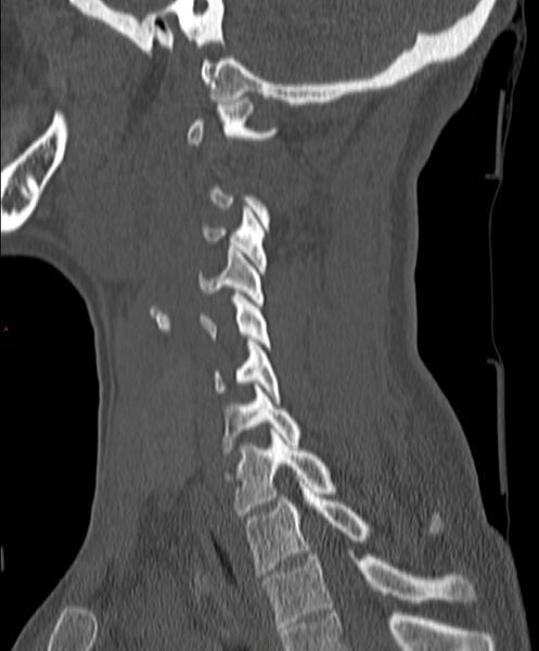 File:Occipital condyle fracture (Radiopaedia 61165-69056 Sagittal bone window 18).jpg