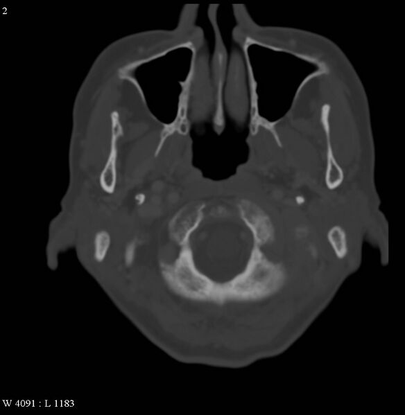 File:Occipital condyle metastasis - into mastoid (Radiopaedia 5424-7177 Axial bone window 2).jpg