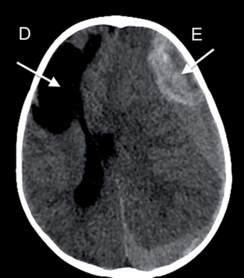 Evidence of intracranial hemorrhage on the left (brain cyst on right)