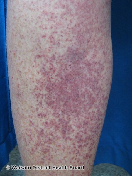 File:Petechiae due to thrombocytopenia (DermNet NZ bleeding-disorder-08).jpg