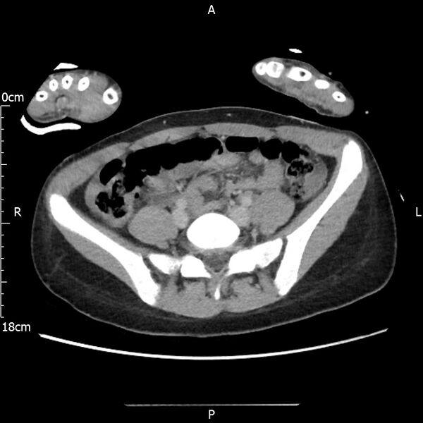 File:AAST grade IV kidney injury with CEUS follow-up (Radiopaedia 72353-82877 Axial C+ portal venous phase 51).jpg