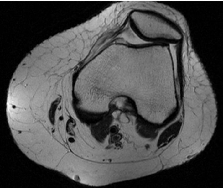 File:ACL mucoid degeneration and ganglion cyst (Radiopaedia 10041-10586 Axial T2 1).jpg