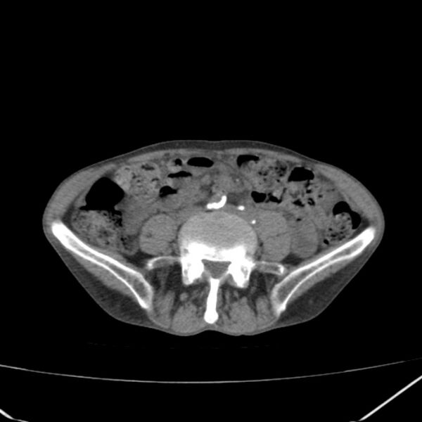 File:Abdominal aortic aneurysm (Radiopaedia 23703-23856 Axial non-contrast 35).jpg