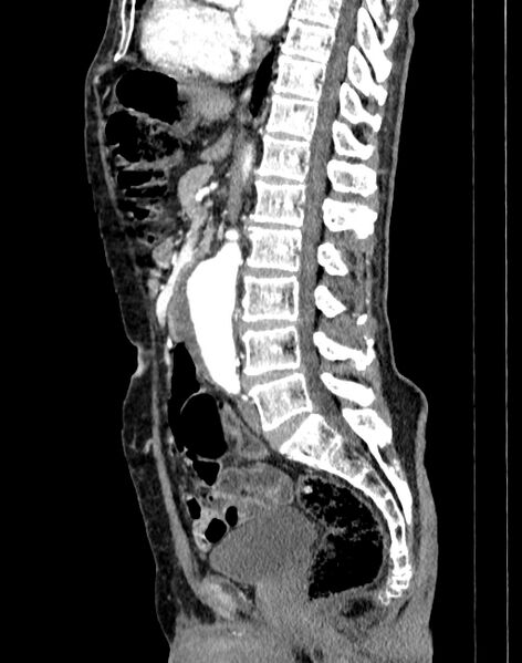 File:Abdominal aortic aneurysm (Radiopaedia 83581-98689 Sagittal C+ arterial phase 44).jpg