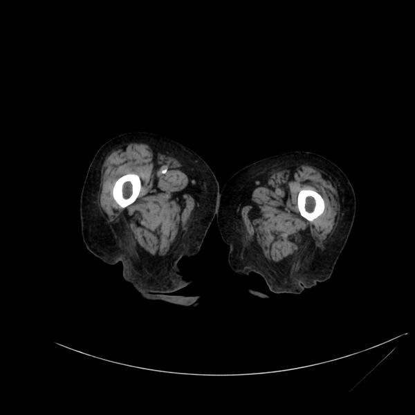 File:Abdominal aortic aneurysm - impending rupture (Radiopaedia 19233-19246 Axial non-contrast 154).jpg