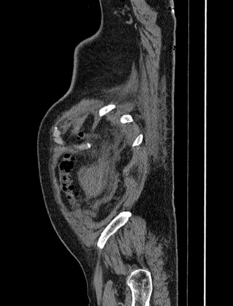File:Abdominal aortic aneurysm rupture (Radiopaedia 54179-60362 Sagittal C+ arterial phase 43).jpg