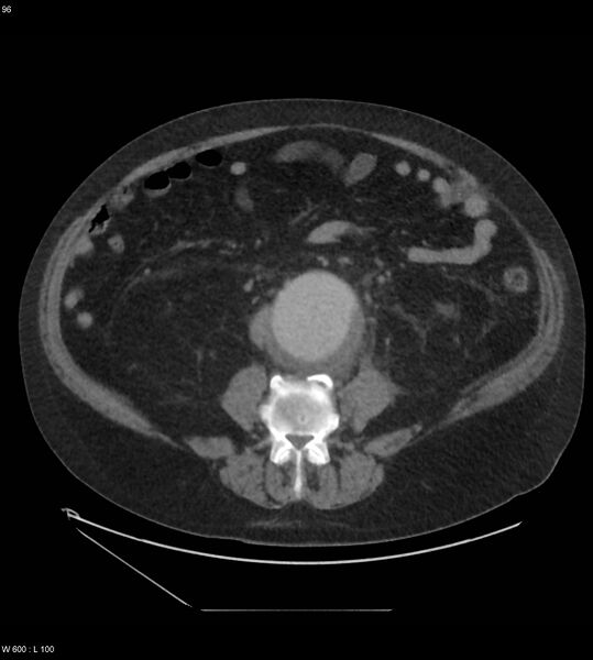 File:Abdominal aortic aneurysm with intramural hematoma then rupture (Radiopaedia 50278-55631 Axial C+ arterial phase 87).jpg