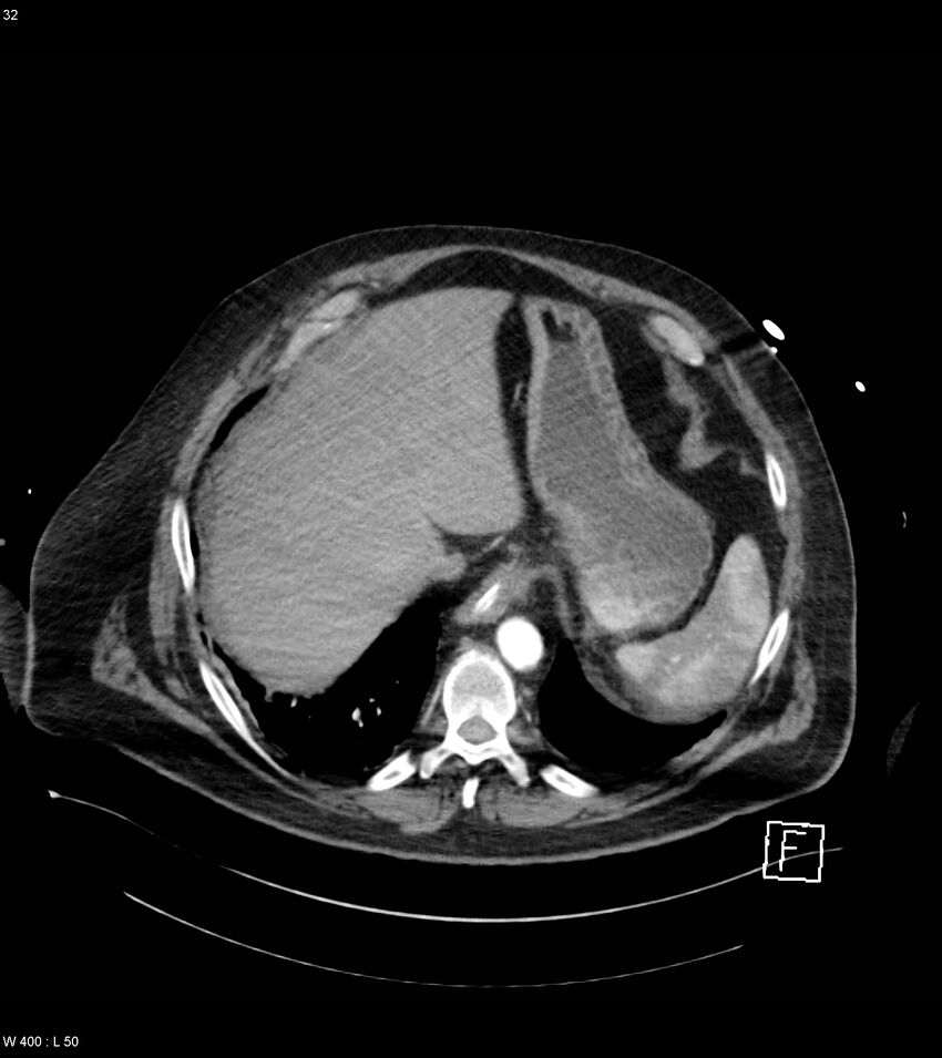 Abdominal aortic aneurysm with intramural hematoma then rupture (Radiopaedia 50278-55632 Axial C+ arterial phase 31).jpg