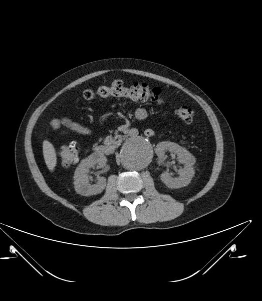 File:Abdominal aortic aneurysm with thrombus fissuration (Radiopaedia 46218-50618 Axial non-contrast 23).jpg