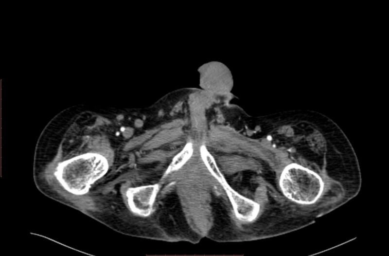 File:Abdominal aortic interposition tube graft and aneurysm thrombosis (Radiopaedia 71438-81857 Axial C+ arterial phase 265).jpg
