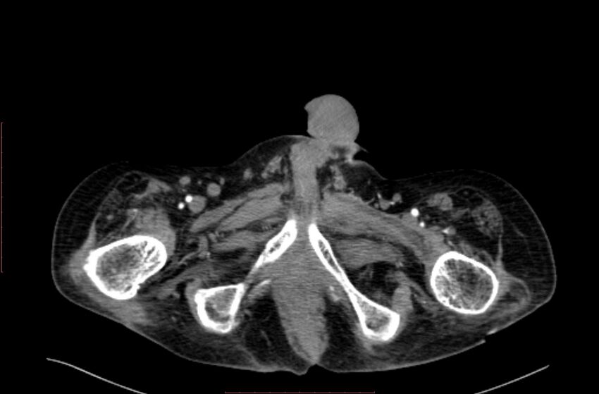 Abdominal aortic interposition tube graft and aneurysm thrombosis (Radiopaedia 71438-81857 Axial C+ arterial phase 265).jpg