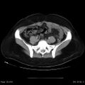 Abdominal wall endometriosis (Radiopaedia 25723-25885 Axial C+ portal venous phase 25).jpg