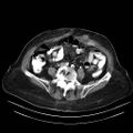 Abdominal wall recurrence after colorectal resection for cancer (Radiopaedia 23444-23523 Axial C+ portal venous phase 23).jpg