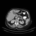 Abdominal wall recurrence after colorectal resection for cancer (Radiopaedia 23444-23523 Axial C+ portal venous phase 7).jpg
