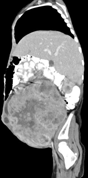 File:Abdominopelvic rhabdomyosarcoma (Radiopaedia 78356-90984 Sagittal C+ portal venous phase 71).jpg
