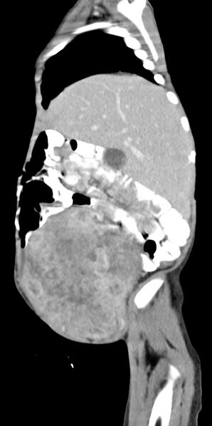 File:Abdominopelvic rhabdomyosarcoma (Radiopaedia 78356-90984 Sagittal C+ portal venous phase 78).jpg