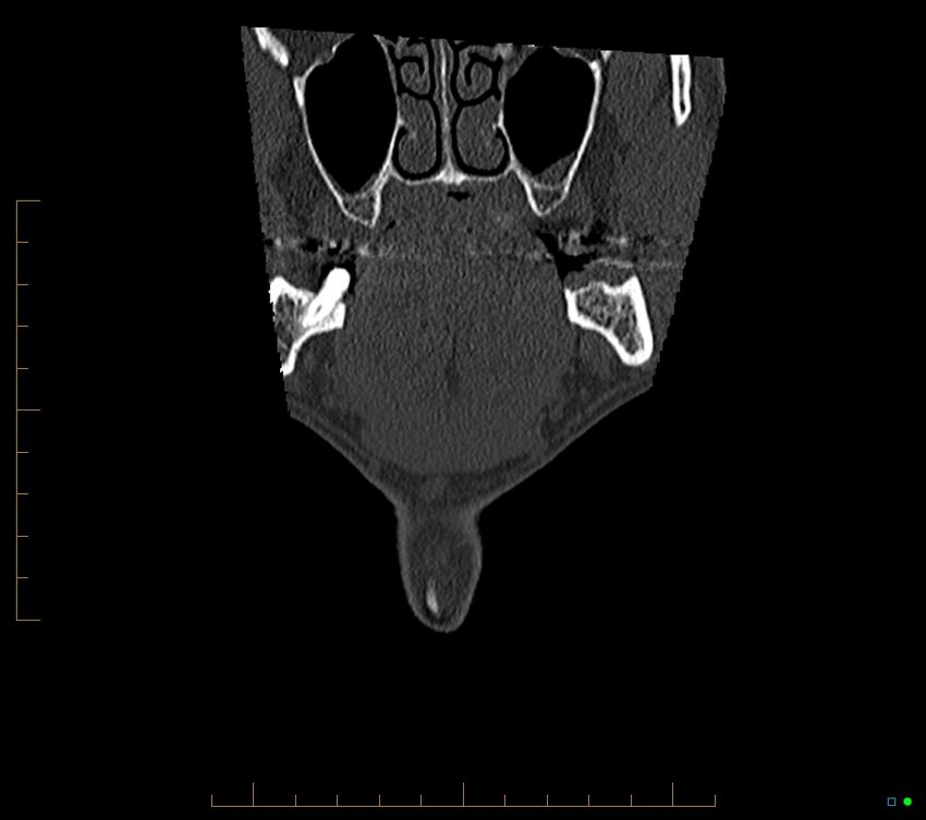 Accessory articulation of cervical transverse processes (Radiopaedia 82715-96933 Coronal non-contrast 3).jpg