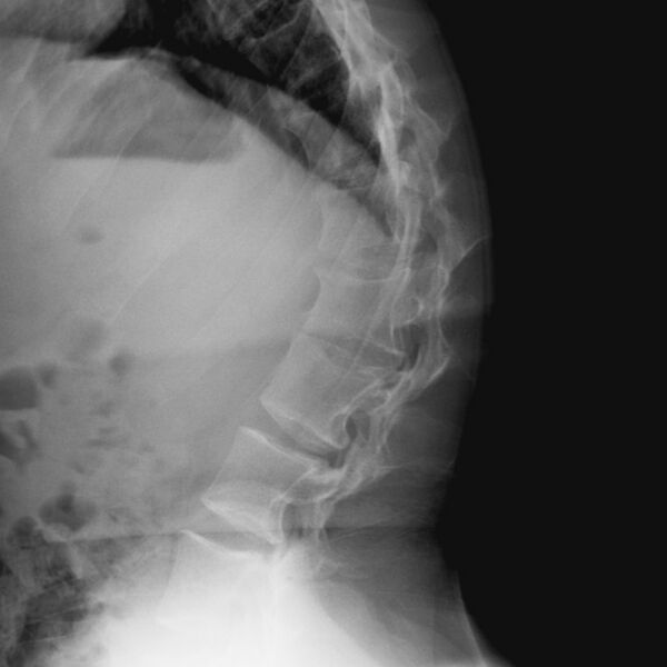 File:Achondroplasia (Radiopaedia 4636-6719 Lateral 1).jpg