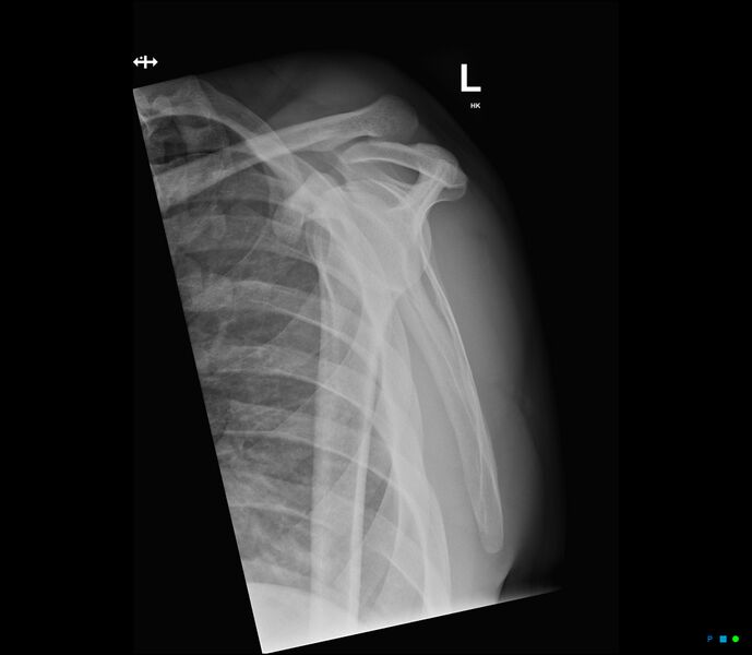 File:Acromioclavicular joint dissociation - type IV (Radiopaedia 64411-73215 Lateral scapular Y view 1).jpg