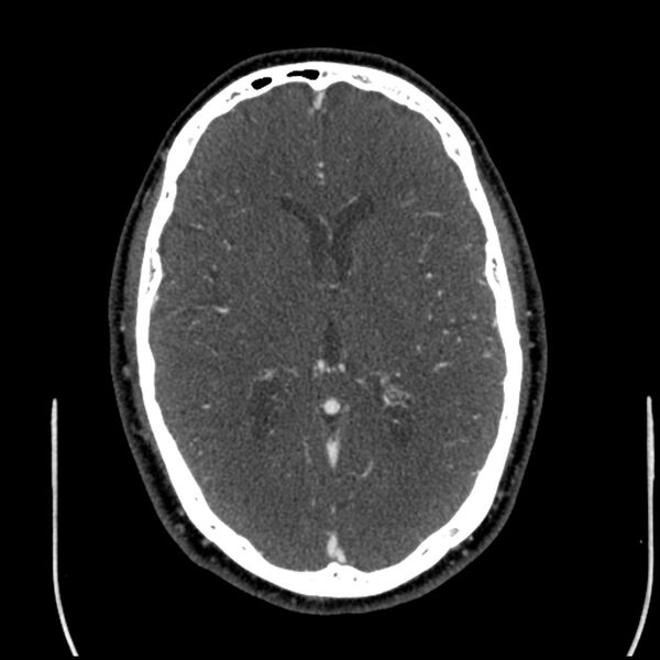 File:Acute A3 occlusion with ACA ischemic penumbra (CT perfusion) (Radiopaedia 72036-82527 Axial C+ arterial phase thins 64).jpg
