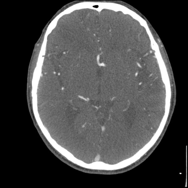 File:Acute P1 occlusion with PCA ischemia penumbra (CT perfusion) (Radiopaedia 72084-82587 Axial C+ arterial thins 15).jpg