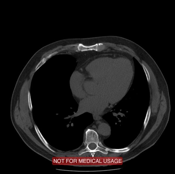 File:Acute aortic dissection - Stanford type A (Radiopaedia 40661-43285 Axial non-contrast 40).jpg