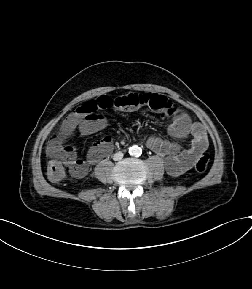 Acute arterial mesenteric ischemia (Radiopaedia 78238-90828 Axial C+ portal venous phase 78).jpg