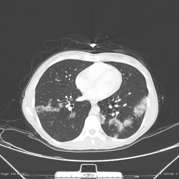 File:Acute eosinophilic pneumonia (Radiopaedia 48211-53073 Axial lung window 56).jpg