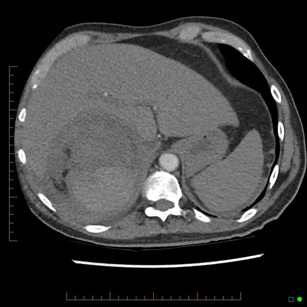 File:Acute hemorrhage into adrenal metastasis from NSCLC (Radiopaedia 43135-46429 Axial C+ CTPA 9).jpg