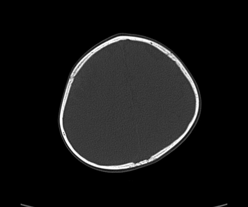 Acute hemorrhagic contusion (Radiopaedia 63660-72336 Axial bone window 52).jpg