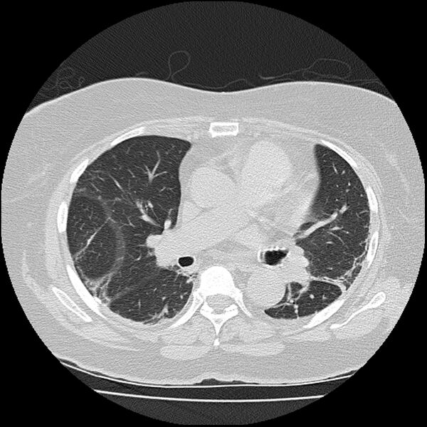 File:Acute interstitial pneumonitis (Radiopaedia 45404-49452 Axial lung window 47).jpg