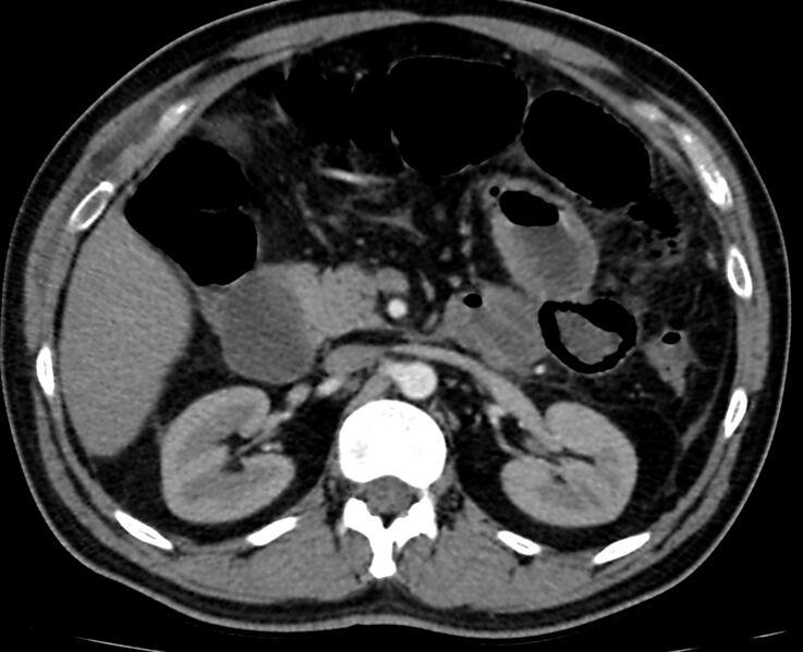 File:Acute mesenteric ischemia - superior mesenteric artery thrombosis (Radiopaedia 73947-84776 Axial C+ arterial phase 32).jpg