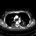 Acute myocardial infarction in CT (Radiopaedia 39947-42415 Axial C+ arterial phase 47).jpg