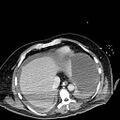 Acute pancreatic necrosis (Radiopaedia 13560-18501 Axial C+ portal venous phase 7).jpg