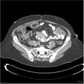 Acute pancreatitis (Radiopaedia 19136-19117 Axial C+ portal venous phase 31).jpg